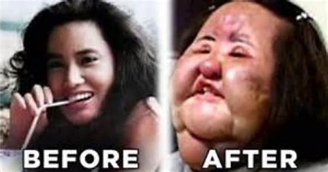 Plastic Surgery Gone Wrong Imgur