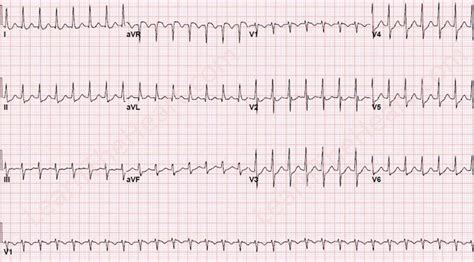 AV Nodal Reentrant Tachycardia AVNRT ECG Example Learn The Heart