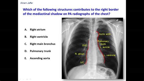 Heart and great vessels — assessment of the cardiovascular anatomy includes assessment of heart and chamber size as well as the position and size of the great. What constitutes the borders of the mediastinal shadow in ...