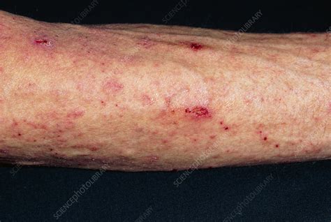 Scabies Skin Infection Seen On Man S Arm Stock Image M260 0161