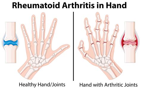 Diagram Showing Rheumatoid Arthritis In Hand 446937 Vector Art At Vecteezy