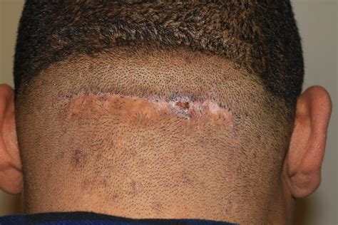 Scalp Keloids Acne Keloidalis Treatment With Cryotherapy