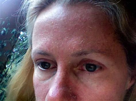 Dry Skin On Face What Causes Itchy Extremely Scaly Severe Patches Flaky And Rash On Face