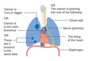 Tests And Stage Of Lung Cancer Mesothelioma Focus