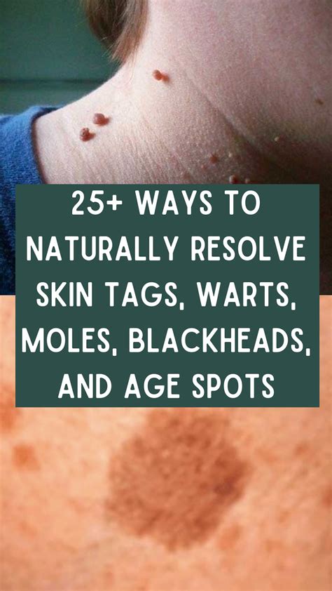 25 Ways To Naturally Resolve Skin Tags Warts Moles Blackheads And
