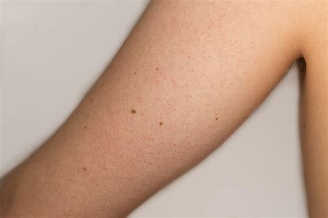 Womens Health On Twitter Itching Skin Skin Bumps Keratosis Pilaris