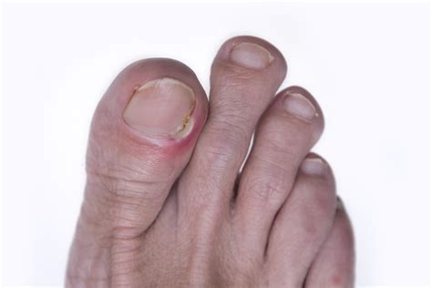 How You Can Prevent And Treat Painful Ingrown Toenails Health