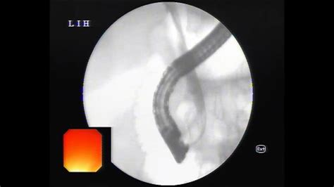 Ercp Biliary Sphincterotomy Cbd Stone Extraction Stenting Youtube