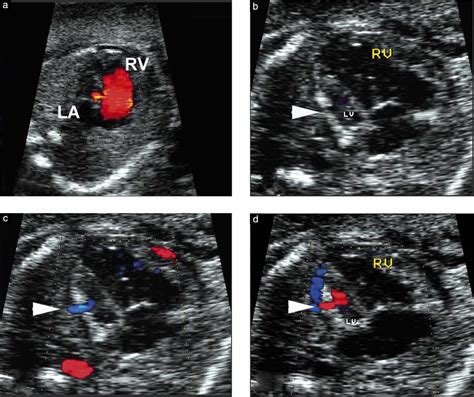 Hypoplastic Left Heart Syndrome Associated With Left Ventriclecoronary