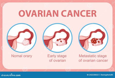 Ovarian Cancer Infographic Infographic Stock Vector Illustration Of