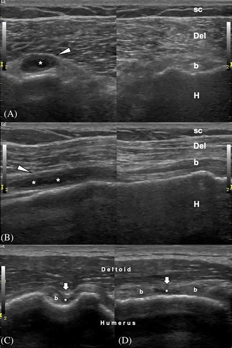Dynamic Ultrasound Examination For Partial Biceps Tendon Rupture Gök