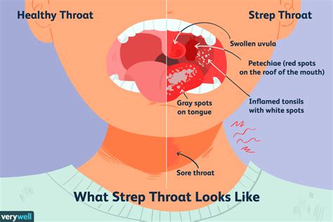 What Is The Difference Between Strep Throat And Cold Chance Phelps