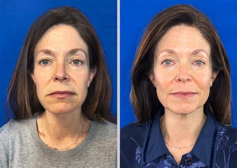 This is an example of the effects of tretinoin after 11 years of constant use (at the time the second photo was taken). Why Do All Dermatologists Use Tretinoin For Anti-Aging ...