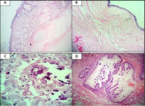Figure 1 From Clinico Pathological Profile Of Ovarian Cysts In A