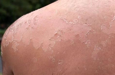 Sunburn Itch Hells Itch Causes Symptoms And How To Get Rid Of It