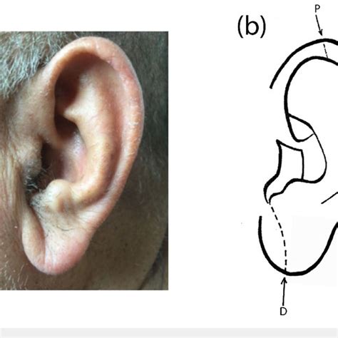 Photograph And Diagram Of The Left Ear A Diagonal Earlobe Crease And