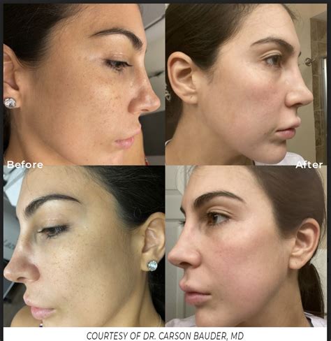 Micro Laser Peel Revive And Refresh