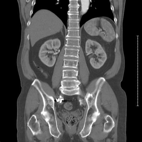 Ct Showing Spine And Kidneys Free Stock Photo By Rudy Liggett On