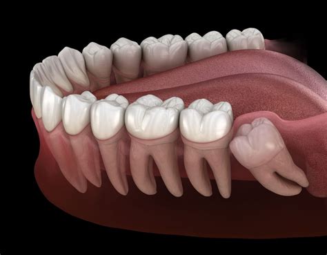 Ways To Reduce Wisdom Tooth Swelling Winning Smiles Dental Surgery