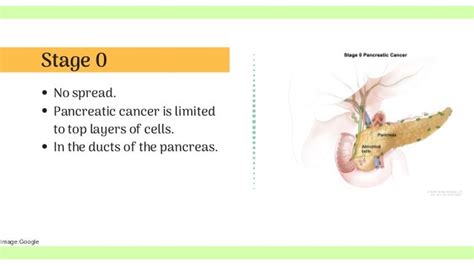 Stages Of Pancreatic Cancer