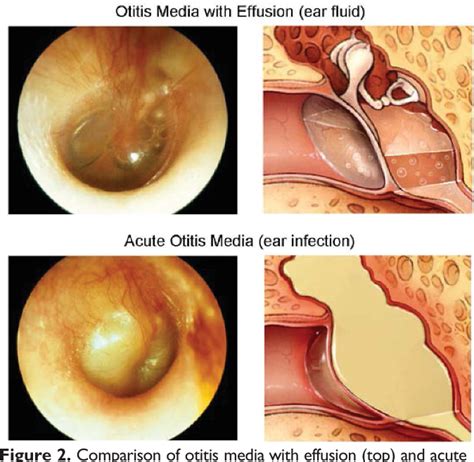 Figure 2 From Clinical Practice Guideline Otitis Media With Effusion