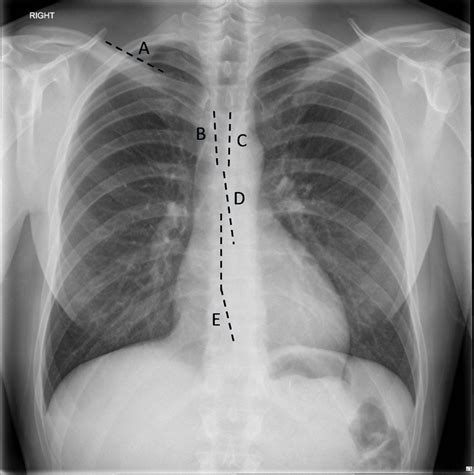 Lines On A Posteroanterior Chest Radiograph The Bmj