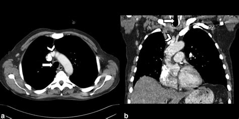 Ct Sections Of The Superior Mediastinum In An Adult Male Patient