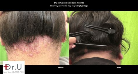 Dr U Clinic Akn Razor Bump Surgical Cure Results In Los Angeles