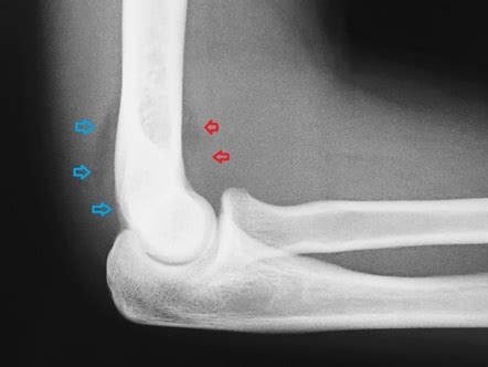 Elbow Joint Effusion Radiology Reference Article Radiopaedia Org
