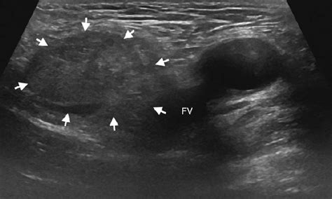 Ultrasound Of Hernias Ultrasound Sonography Medical Images And Photos