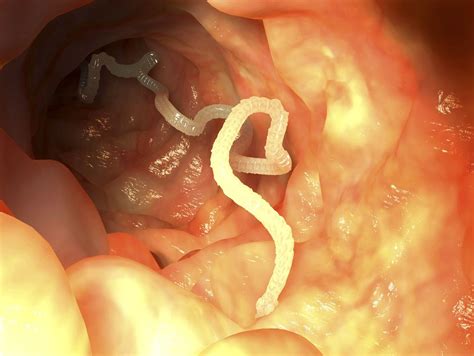Tapeworm Symptoms Transmission And Prevention