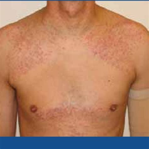 Pdf Erlotinib Induced Rash Spares Previously Irradiated Skin