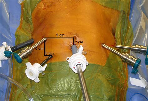 Extended Pelvic Lymph Node Dissection In Robotic Assisted Radical Prostatectomy Surgical