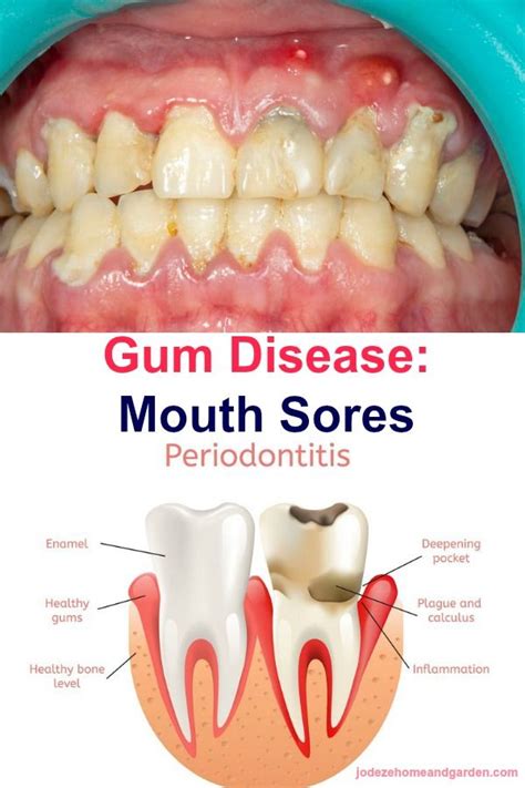 How To Avoid Tooth Loss From Gum Disease Gum Disease Tooth Decay