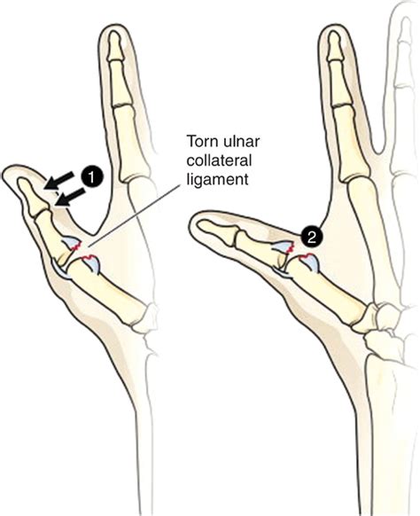 Ulnar Collateral Ligament Tear Of The Thumb Ski Pole Or Gamekeepers