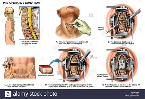 Spine Surgery C Anterior Cervical Discectomy Diskectomy And Stock
