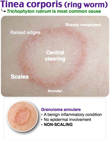 Tinea Versicolor Vs Eczema