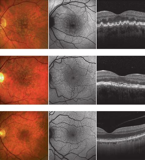 2 A C Subtypes Of Amd Related Drusen From Left To Right Fundus