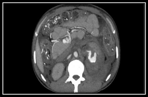 Ct Scan Abdomen With Contrast Showed Pseudoaneurysm Formation And Large