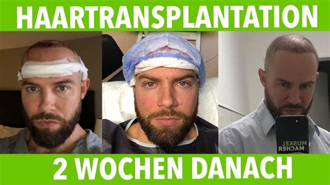 Meine Haartransplantation Bei Elithairtransplant In Istanbul 2 Wochen