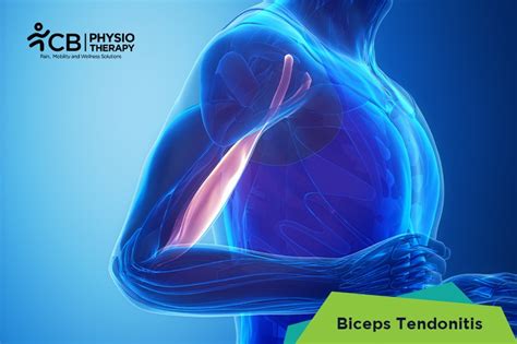 What Is Biceps Tendonitis Symptoms Causes Diagnosis And Physiotherapy
