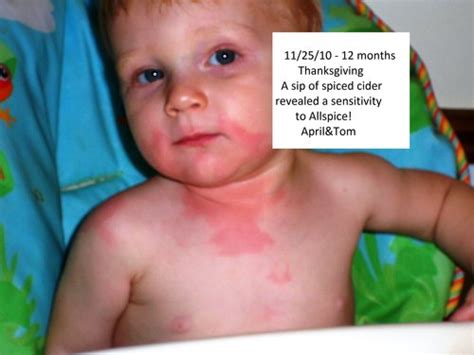 Baby Food Allergy Rash Pictures Baby With Dermatitis Problem Of Rash