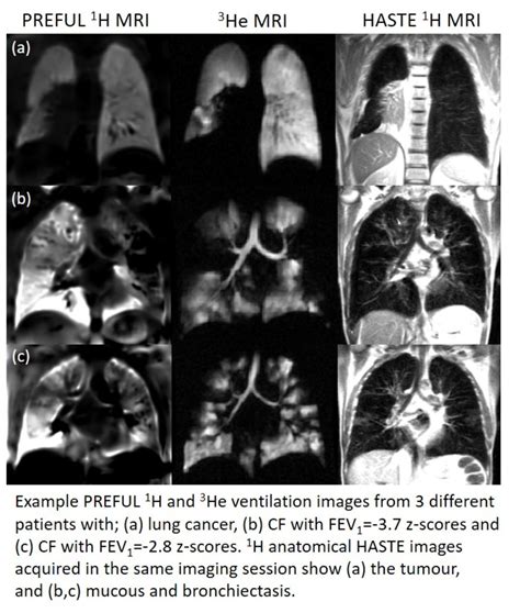 Comparison Of 1h Mri And 3he Mri Ventilation Images In Patients With