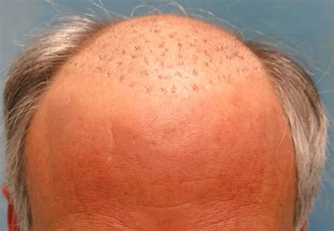 Plug Removal Repair Hair Transplant Medlinks