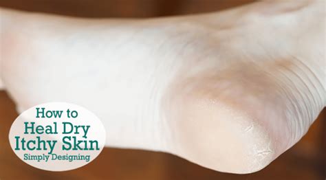 How To Heal Dry Itchy Skin Simply Designing With Ashley