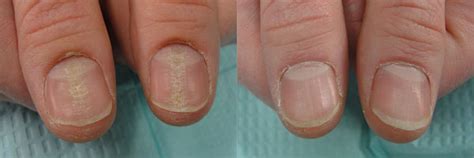 Nail Case Studies — Dr Dana Stern Dermatologist Nail Specialist