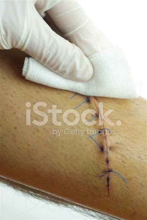 Cleaning Stitched Wound Stock Photos