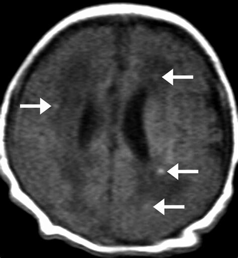 Hypoxic Ischemic Brain Injury Imaging Findings From Birth To Adulthood