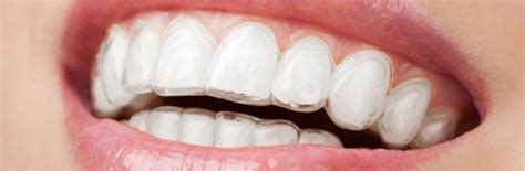 Everything You Need To Know About Clear Braces Docklands Dental