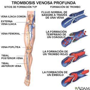 Trombosis Venosa Profunda Care Guide Information En Espanol